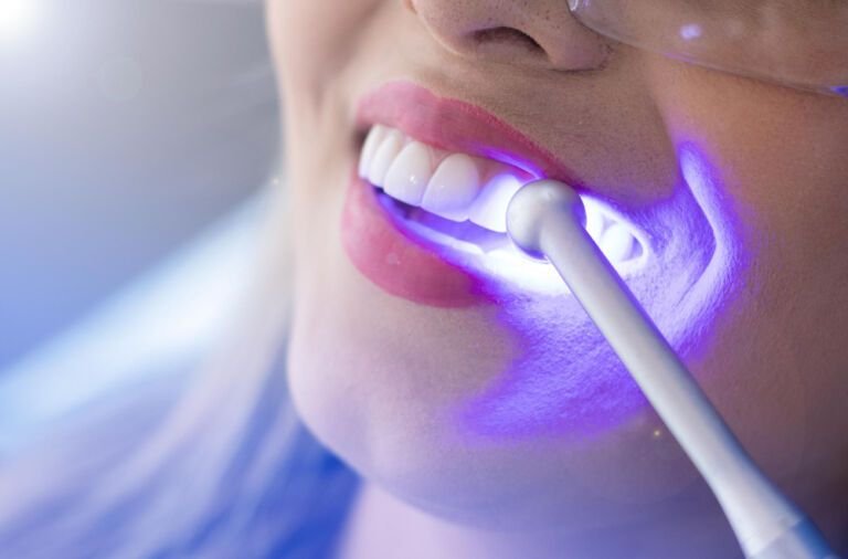 clareamento dental de consultorios sendo aplicado aos dentes do paciente