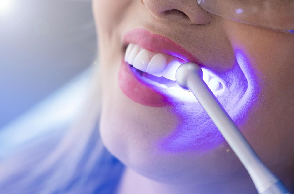 clareamento dental de consultorios sendo aplicado aos dentes do paciente